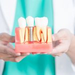 Что такое процедура зубной имплантации?