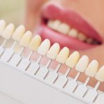 Как имплант зуба изменит вашу улыбку: подробный обзор