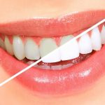 Блискуча Усмішка: Ефективні Методи Відбілювання Зубів