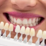 Преображение улыбки: коронки и виниры, которые изменят ваше восприятие стоматологии